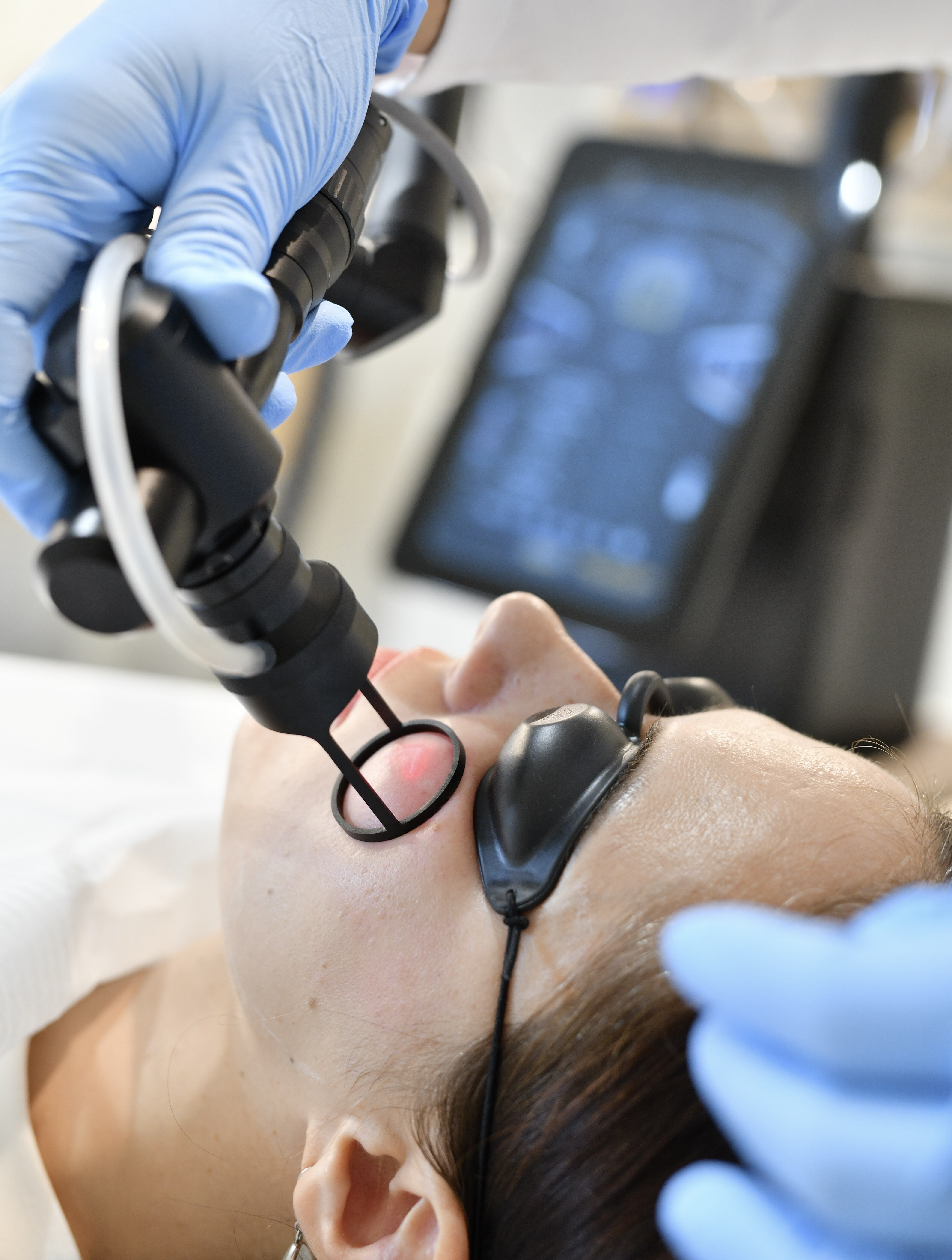 Fraksjonell CO2 laser i aksjon